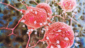 Closeup of lung cancer cells under a microscope