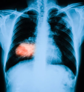 A chest X-ray showing a lung cancer tumor in the left lung