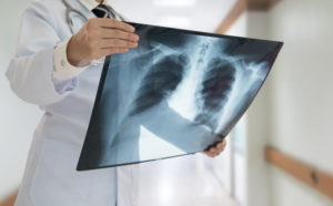 A doctor holds up a chest X-ray.