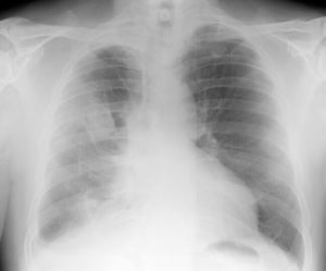 A black and white chest X-ray.