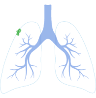 Stage 1 Lung Cancer Symptoms