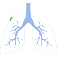 Stage 1 Mesothelioma