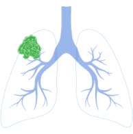 Stage 2 Lung Cancer Symptoms