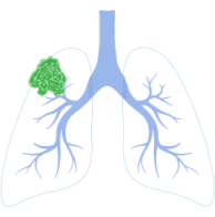 Stage 2 Lung Cancer Survival Rate