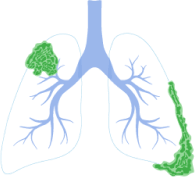 Stage 3 Lung Cancer Symptoms