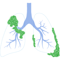 Stage 4 Lung Cancer Symptoms