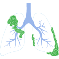 Stage 4 Lung Cancer Survival Rate