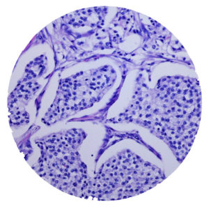 Bronchial Carcinoids