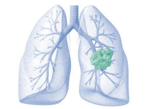 illustration of the lungs with a tumor in the right lung
