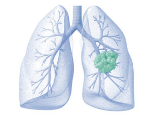 Image of a bronchial carcinoid tumor in the right lung