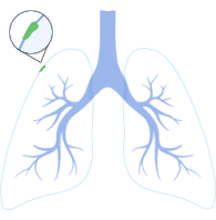 Stage 0 Lung Cancer Symptoms