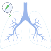 Stage 0 Lung Cancer Symptoms