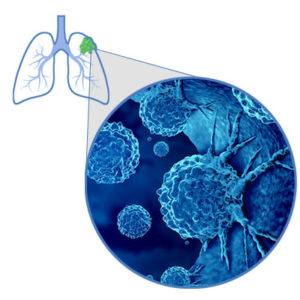 A closeup of non-small cell lung cancer cells within the lungs. They are circular in shape.