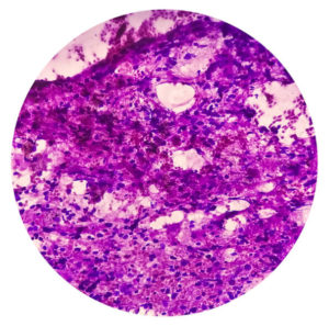 Combined Small Cell Lung Carcinoma