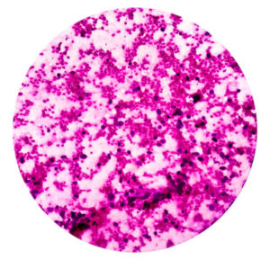 Small Cell Carcinoma