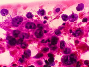 Dark purple lung cancer cells against a pink background. Microscopic view of lung cancer cells.