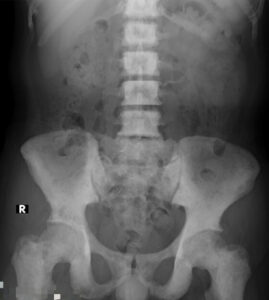 X-ray of a pelvis