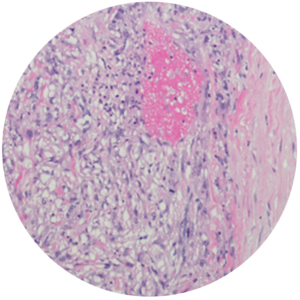 Sarcomatoid Mesothelioma Prognosis