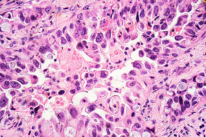 Adenocarcinoma cells