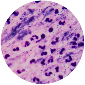 Biphasic mesothelioma