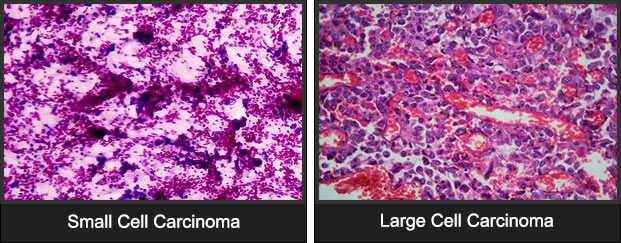 Examples of Small and Large Cell Carcinoma