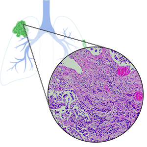 Squamous Cell Carcinoma