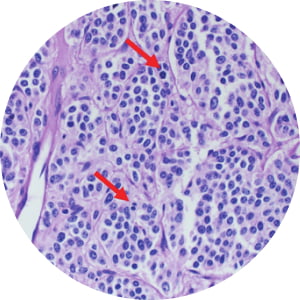 Image of Atypical Carcinoids