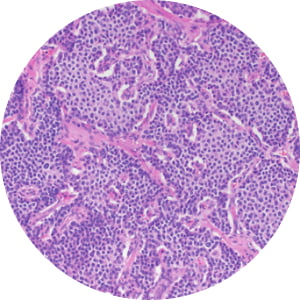 Image of Typical Carcinoids