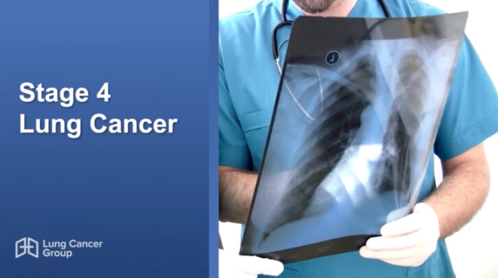 Stage 4 Lung Cancer Video Thumbnail